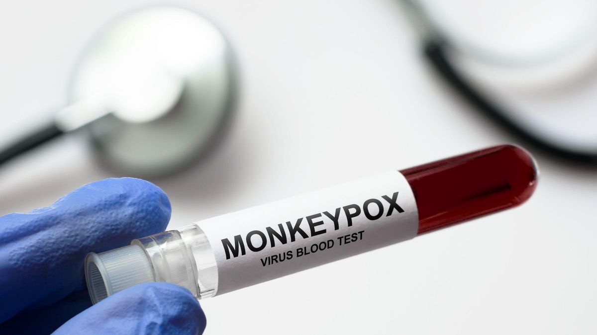 Opičí neštovice se mohou znovu rozšířit po festivalech, říká lékař